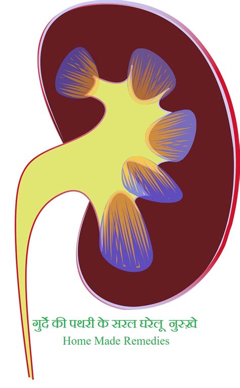 5 Ways Remove Kidney Stone In Hindi