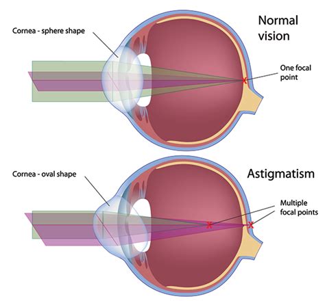 Astigmatism Fort Worth Optometrist Fort Worth Refractive Surgery Fort Worth