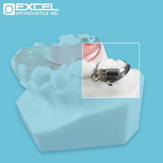 Clasp Options Excel Orthodontics