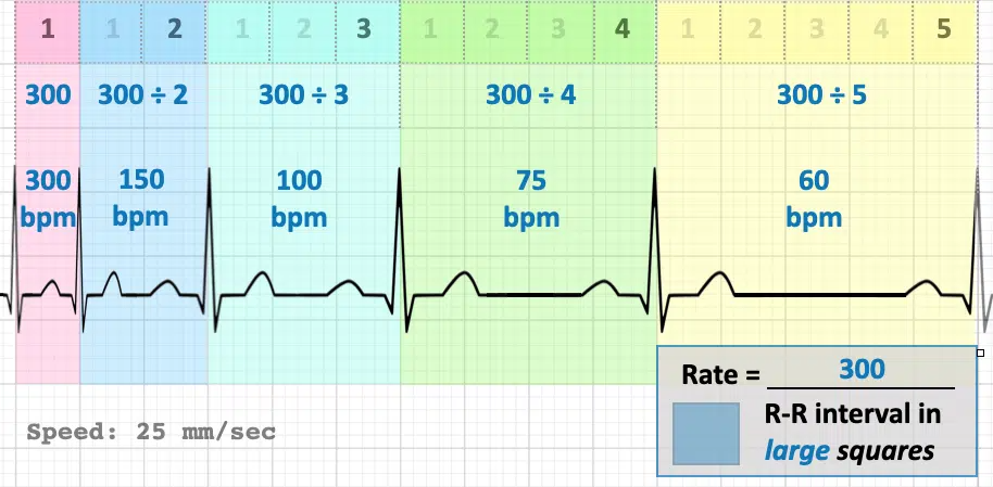 Ecg Rate Interpretation Litfl Medical Blog Ecg Library Basics