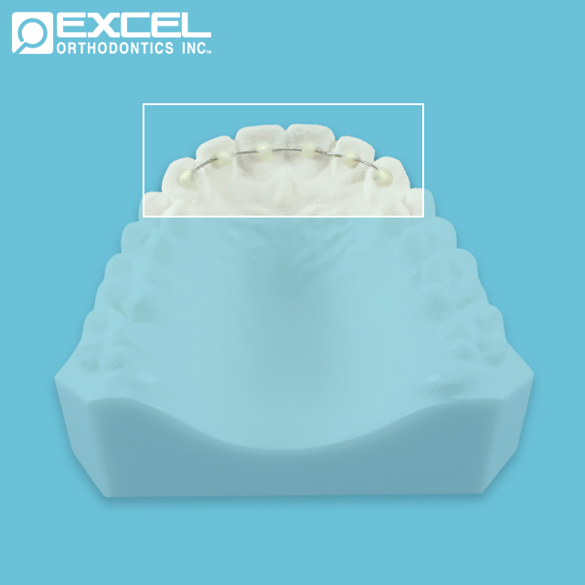 Fixed Retainer Options Excel Orthodontics