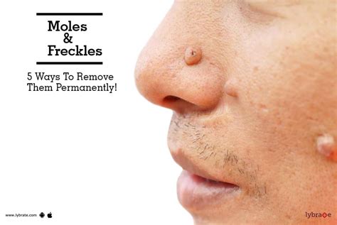 Moles Amp Freckles 5 Ways To Remove Them Permanently By Dr Prashantha Kesari Lybrate